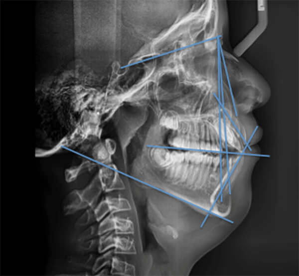 Fig. 1 Radiografía lateral de cráneo