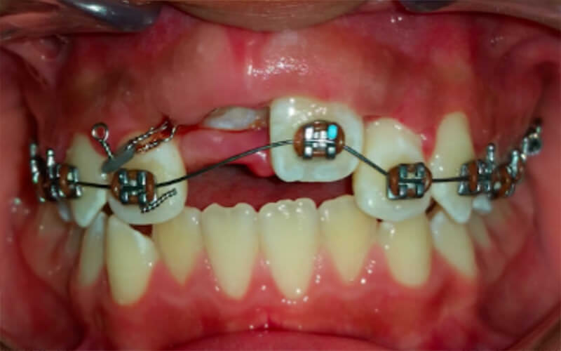 Fig 11. Imagen intraoral frente  con la mecánica de tracción.