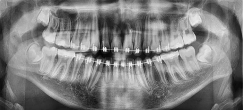 Fig. 12 Radiografía panorámica de progreso