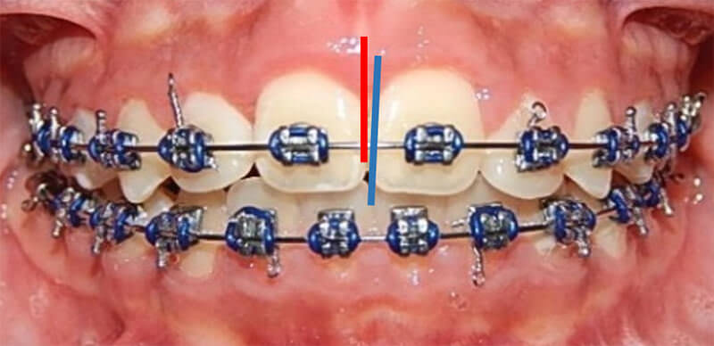 Fig. 13 Intraoral de progreso