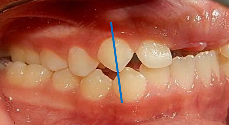 Fig. 16 Lateral derecha de inicio