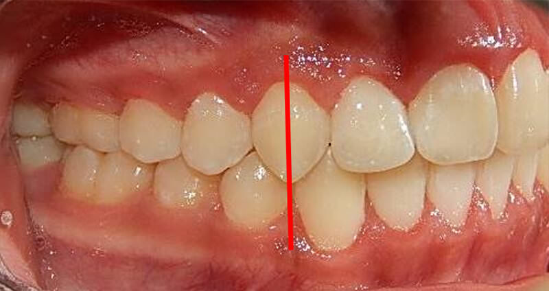 Fig. 17 Lateral derecha final