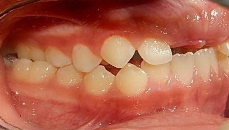 Fig. 3 Lateral derecha