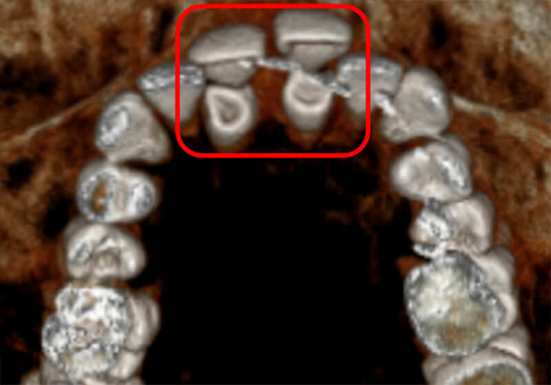 Fig. 7 Tridimensional (cone beam)