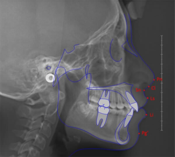 Puntos cefalométricos localizados en el perfil de tejidos blandos