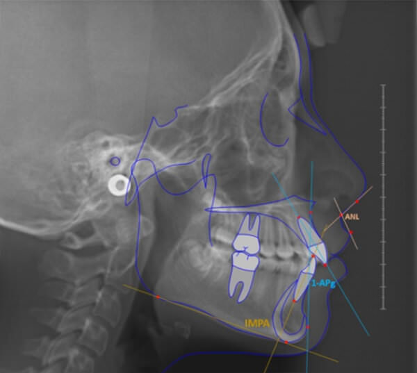 Ángulos que determinaron los cambios dentarios en la muestra estudiada