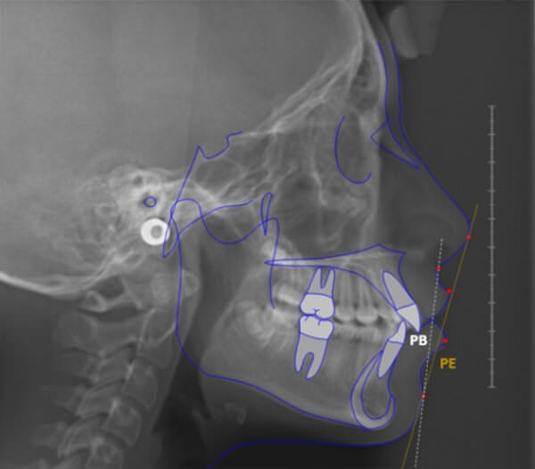 Planos que determinaron los cambios a nivel de los labios en la muestra estudiada