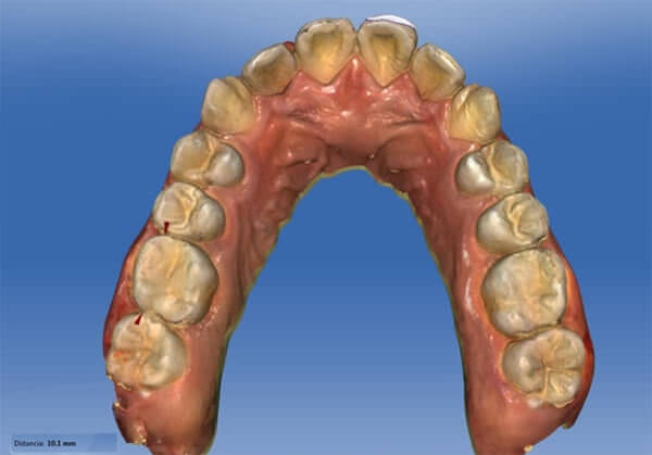 Imagen 1. Medición en los modelos de yeso.