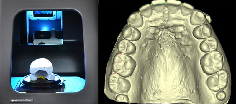 Imagen 3. Modelos digitales obtenidos escáner extraoral Dental Scanner SMART.