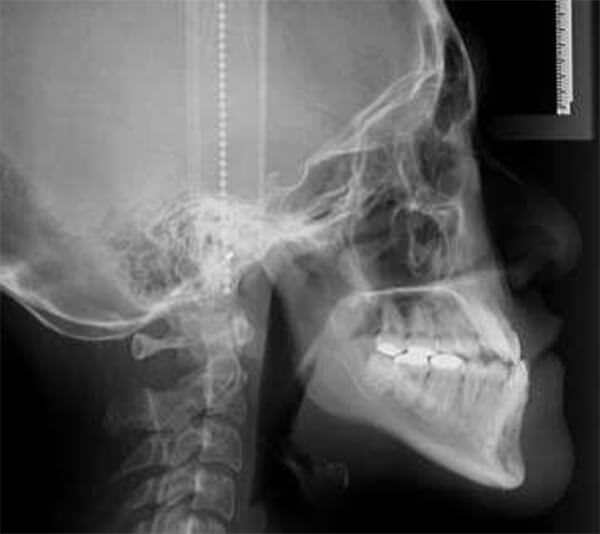 Fig. 1 Radiografía lateral de cráneo