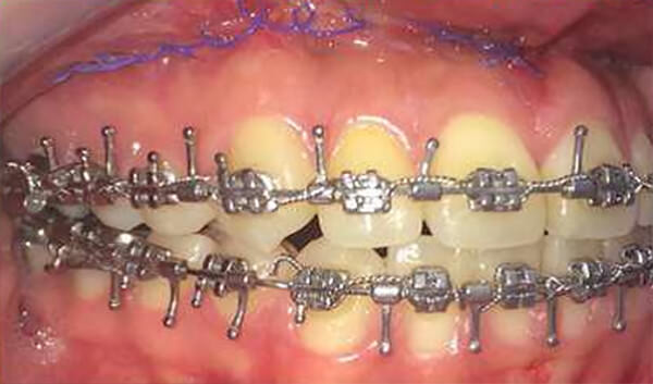 Fig. 11 Lateral derecha