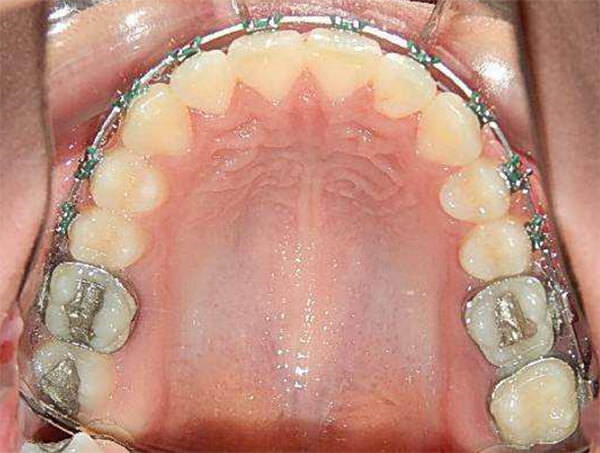 Fig. 17 Oclusal superior