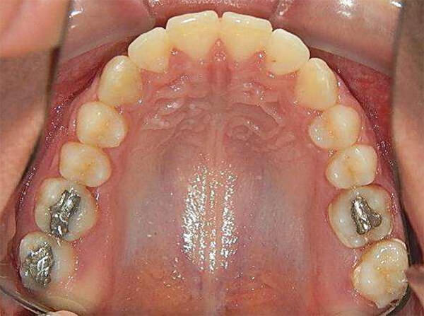 Fig. 23 Oclusal superior