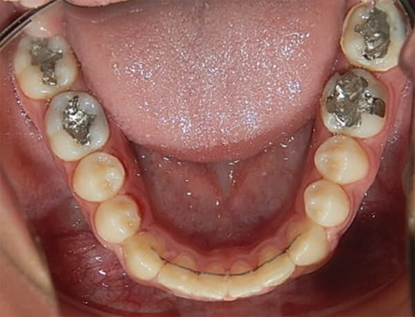 Fig. 24 Oclusal inferior