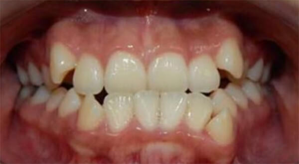 Fig. 27 comparaciones inicio y final  intraoral de frente