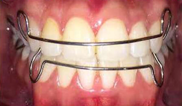 Fig. 29 Retenedores intraoral de frente