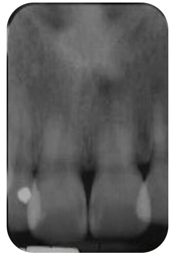 Fig. 9 Radiografía periapical