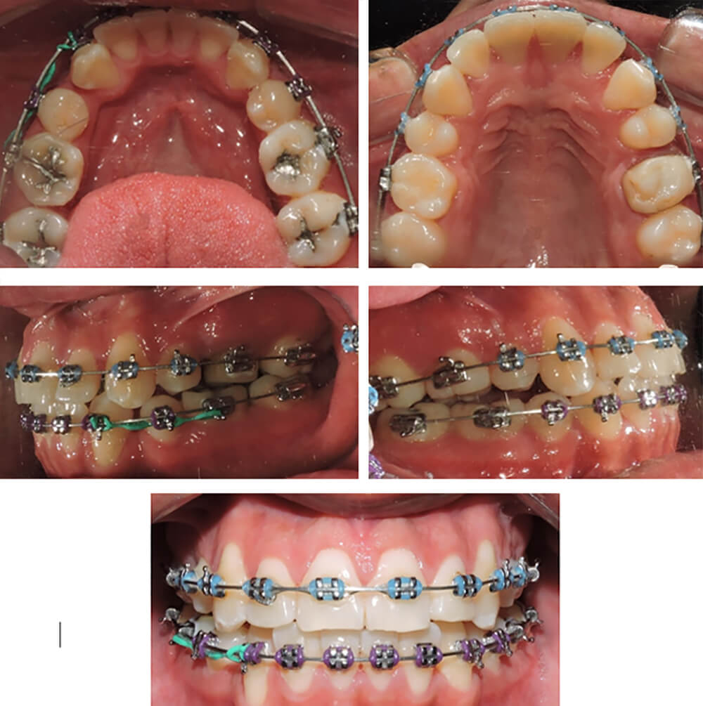 Fig 4. Fotografias intraorales paciente clase lll tratado con camuflaje (evolución durante el tratamiento).