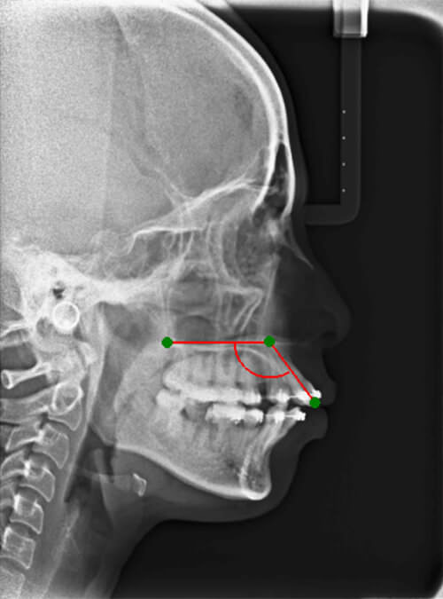 Fig.2: UI-PP angle