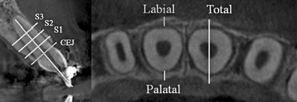 Fig.3: Measurement of alveolar bone thickness at different levels