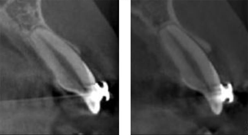 Fig.4: Changes in alveolar bone thickness on labial aspect of the anterior teeth during anterior retraction.