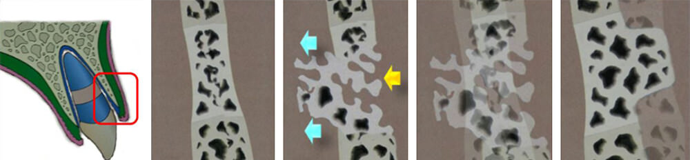 Fig.5: Illustration of secondary bone remodeling process may not be able to catch up with too rapid tooth movement.