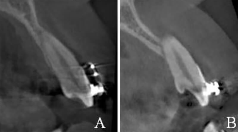Fig.6: 1 of 15 cases exhibited root perforation, labial bone fenestration and dehiscence at apical level. (A: Before incisor retraction B: After incisor retraction)
