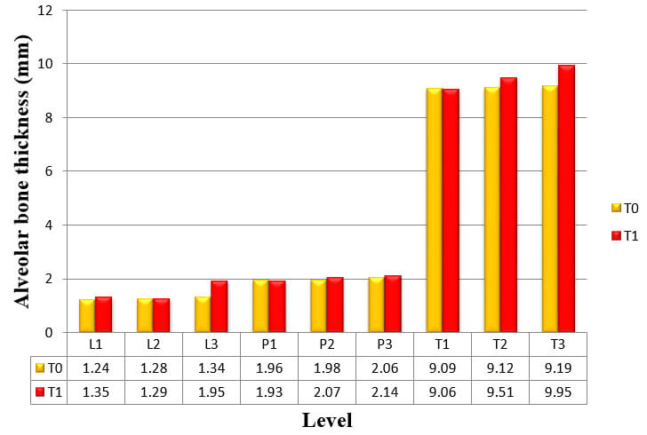 Graph 3: Mean alveolar bone thickness of six anterior teeth at T0 and T1 measurements