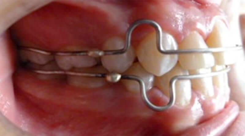 Fig. 15a Intraoral lateral derecha final
