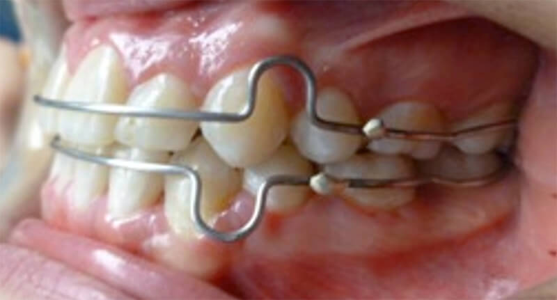 Fig. 15b Intraoral lateral izquierda final