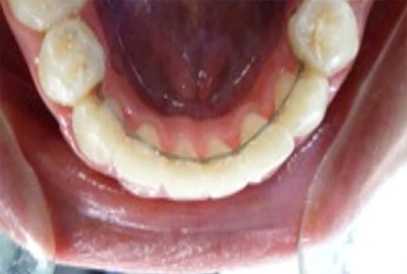 Fig. 17 Vista oclusal, retenedor fijo premolares