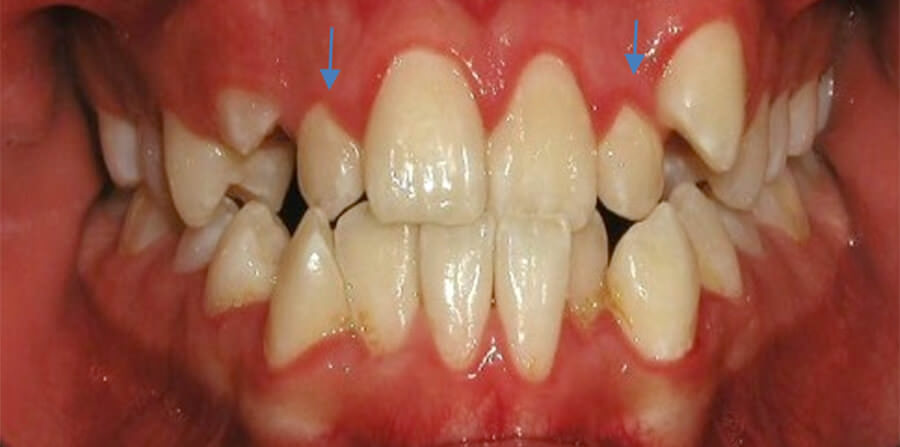 Fig. 3 Intraoral de frente