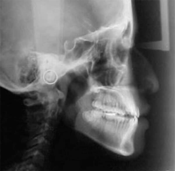 Fig. 6 Radiografía lateral de cráneo