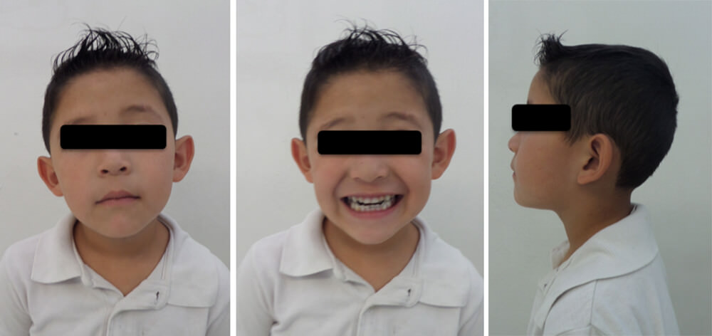 Figure 4. Extra oral photos: Frontal. Frontal smiling. Facial profile.
