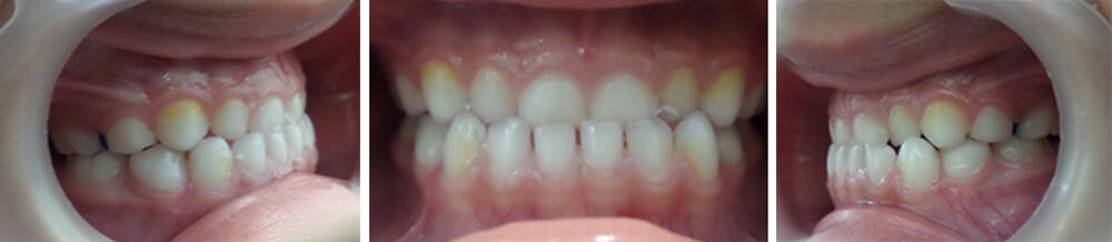 Figure 2. Photos showing frontal crossed bite in deciduous dentition.