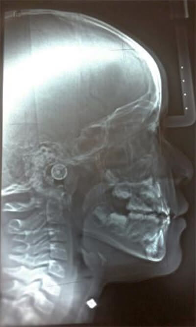 Figure 3. Lateral x-ray of the skull and Ricketts cephalometric outlines. Source: own