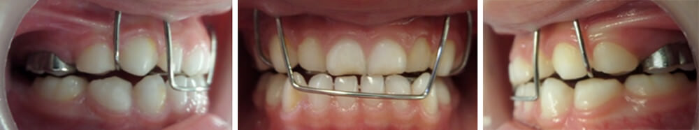 Figura 5. Intraoral photos with PFOD evidencing change of therapeutic posture.