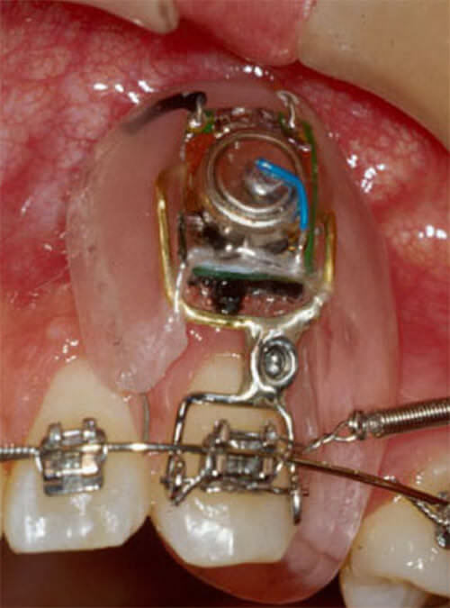 Fig. 4. Aplicador eléctrico, colocado en canino superior izquierdo. Cortesía del Doctor Young Guk Park