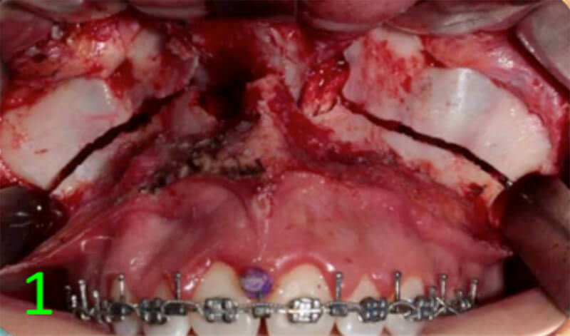 Fig 10. Impactación del maxilar