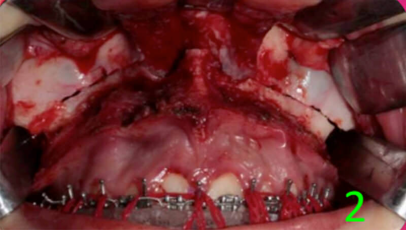 Fig 10. Impactación del maxilar