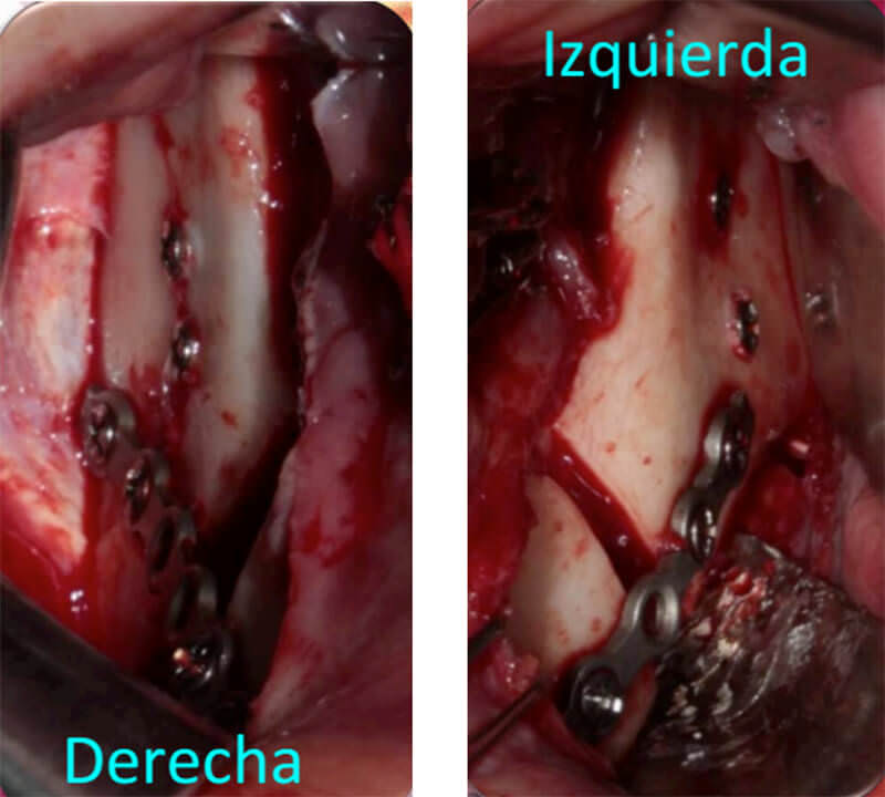 Fig. 11 Osteotomía sagital de rama