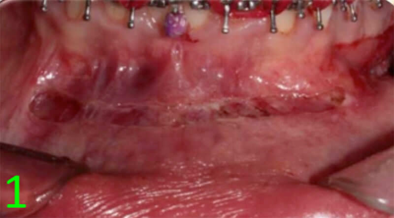 Fig. 12 Mentoplastía de avance horizontal