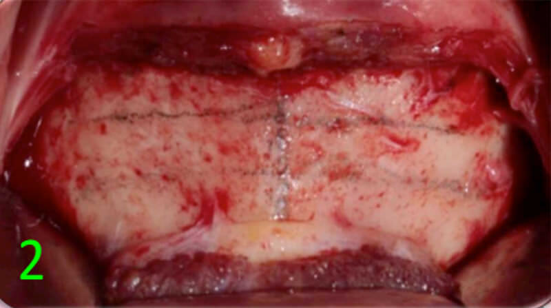 Fig. 12 Mentoplastía de avance horizontal