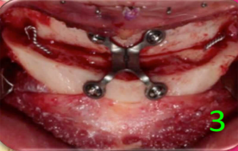 Fig. 12 Mentoplastía de avance horizontal