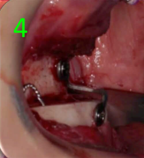 Fig. 12 Mentoplastía de avance horizontal