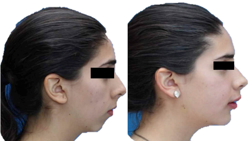 Fig. 13 perfiles inicio final comparativa