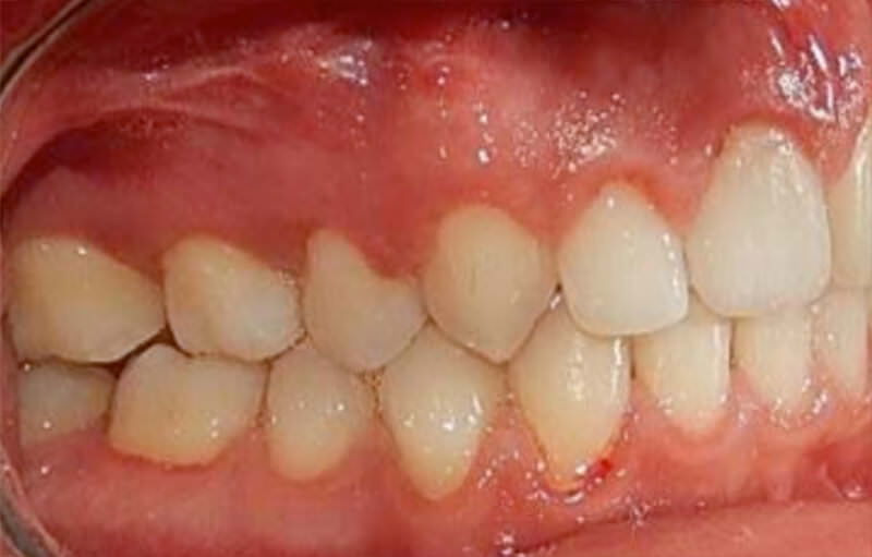 Fig. 14 Extraorales finales