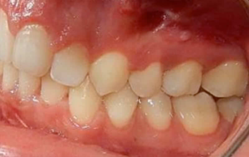 Fig. 14 Extraorales finales