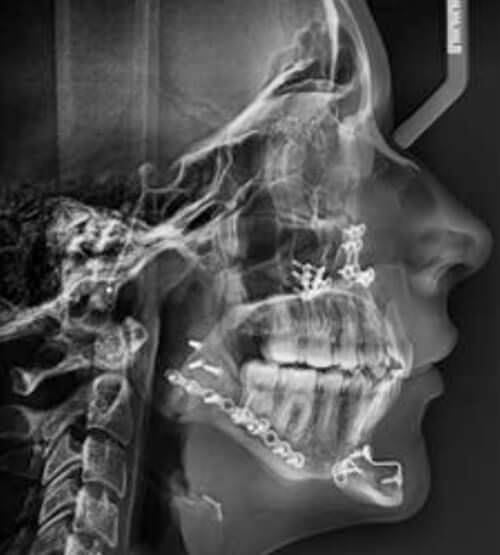 Fig. 15 Radiografías finales