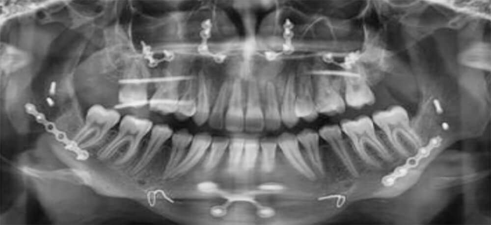 Fig. 15 Radiografías finales